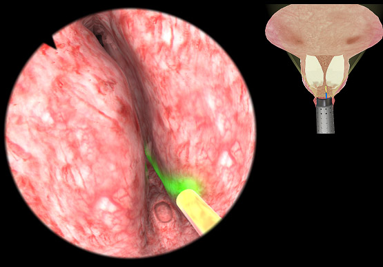 VirtaMed UroS - BPH laser module